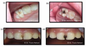 Silver Diamine Fluoride (SDF) before and after. J. Maclean, T. Nelson