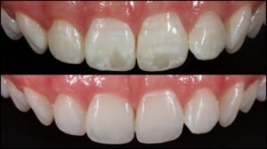 ICON Resin Infiltration Before and After