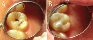 Interim Therapeutic Restorations (ITR)